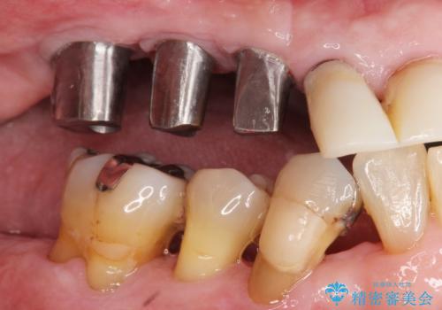 歯がぐらぐら 上顎洞底挙上術を併用した奥歯のインプラント 50代男性の治療後