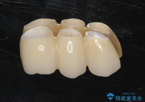 歯がぐらぐら 上顎洞底挙上術を併用した奥歯のインプラント 50代男性の治療中