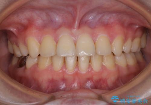 治療の前にPMTCできれいでツルツルな歯にの症例 治療前