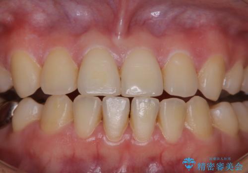 治療の前にPMTCできれいでツルツルな歯にの治療前