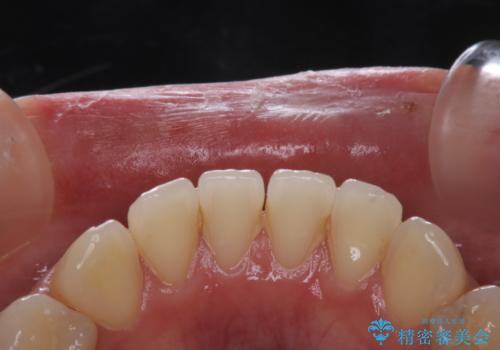 治療の前にPMTCできれいでツルツルな歯にの治療前