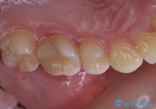 治療の前にPMTCできれいでツルツルな歯にの治療前