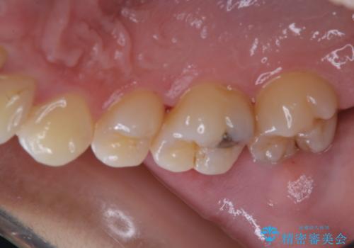 治療の前にPMTCできれいでツルツルな歯にの治療前