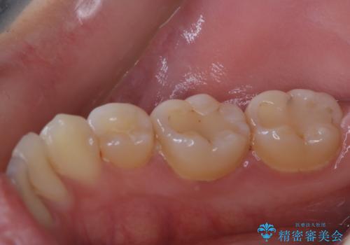 治療の前にPMTCできれいでツルツルな歯にの治療前