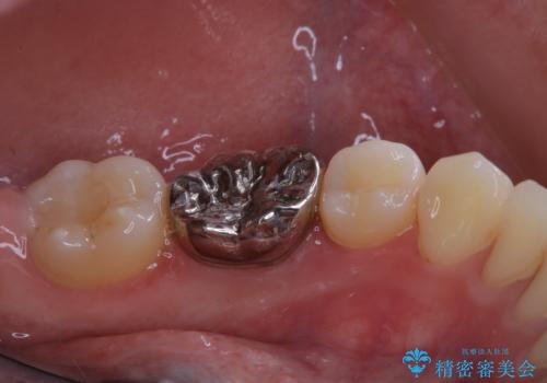 治療の前にPMTCできれいでツルツルな歯にの治療前