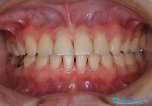 治療の前にPMTCできれいでツルツルな歯にの症例 治療後
