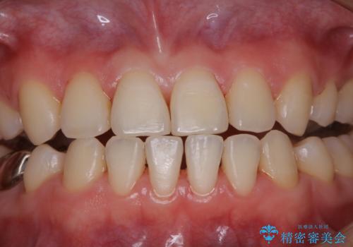 治療の前にPMTCできれいでツルツルな歯にの治療後