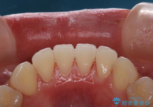 治療の前にPMTCできれいでツルツルな歯にの治療後