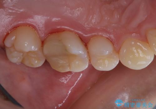 治療の前にPMTCできれいでツルツルな歯にの治療後