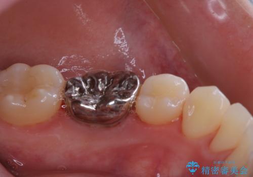 治療の前にPMTCできれいでツルツルな歯にの治療後