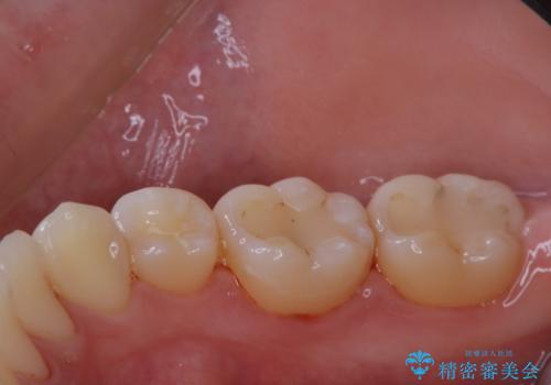治療の前にPMTCできれいでツルツルな歯にの治療後