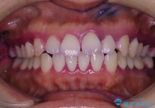 インビザラインの開始前に歯磨きのチェックとPMTCの治療前