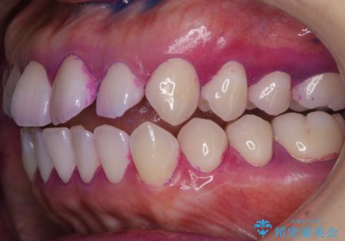 インビザラインの開始前に歯磨きのチェックとPMTCの治療前