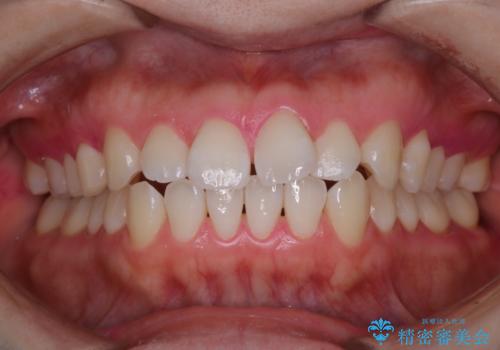 インビザラインの開始前に歯磨きのチェックとPMTCの治療後