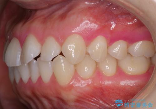 インビザラインの開始前に歯磨きのチェックとPMTCの治療後