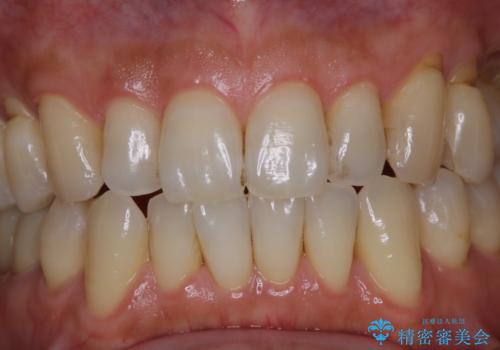 PMTCでメンテナンスの治療前