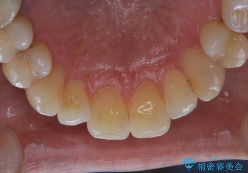 PMTCでメンテナンスの治療前