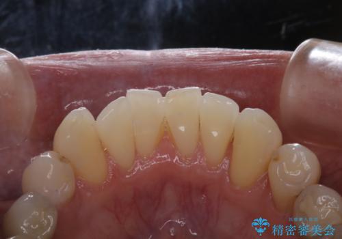 PMTCでメンテナンスの治療前