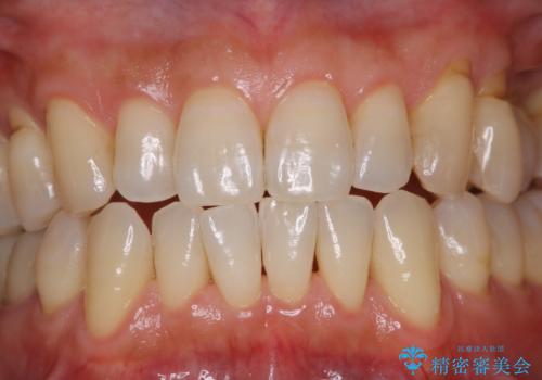 PMTCでメンテナンスの治療後