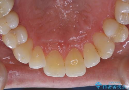 PMTCでメンテナンスの治療後