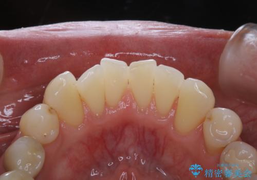 PMTCでメンテナンスの治療後