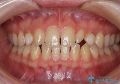 前歯の奇形歯　オールセラミッククラウンによる審美歯科治療の治療前