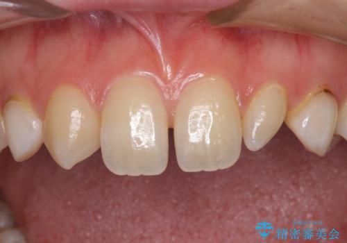 前歯の奇形歯 オールセラミッククラウンによる審美歯科治療の治療前