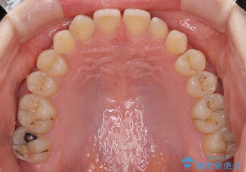 前歯の奇形歯 オールセラミッククラウンによる審美歯科治療の治療前