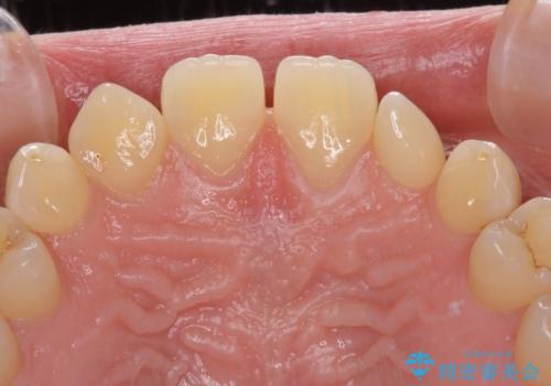 前歯の奇形歯　オールセラミッククラウンによる審美歯科治療の治療前