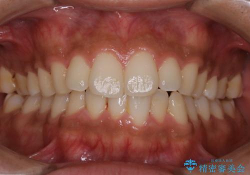 初めてのPMTCの治療前