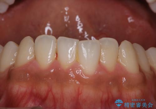 初めてのPMTCの治療前