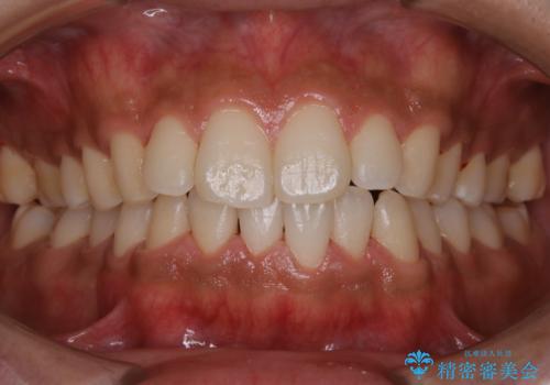 初めてのPMTCの治療後