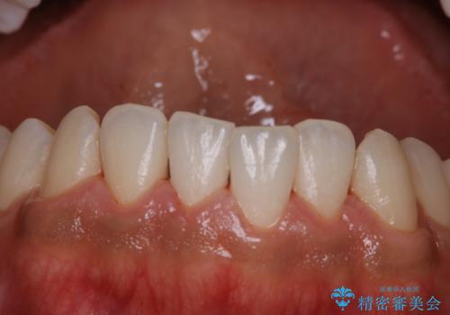 初めてのPMTCの治療後