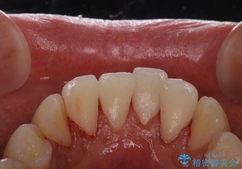 初めてのPMTCの症例 治療後