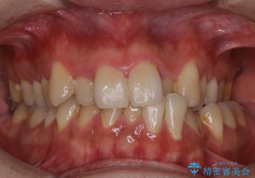 1年ぶりの歯医者でクリーニングの治療前