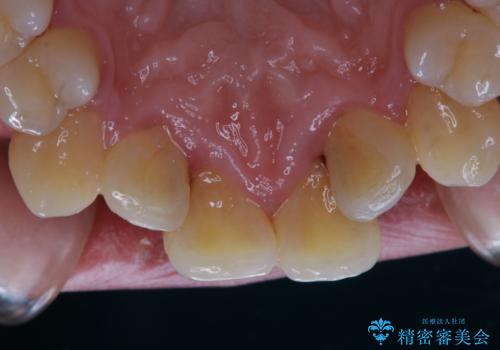1年ぶりの歯医者でクリーニングの治療前