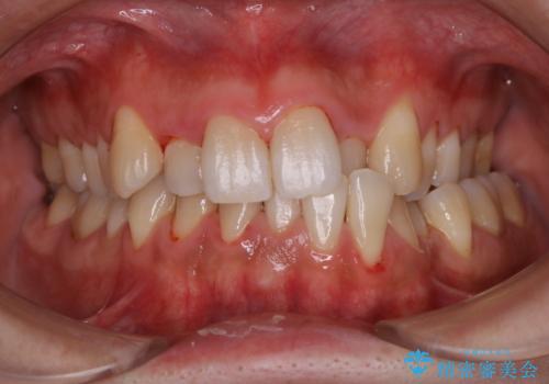 1年ぶりの歯医者でクリーニングの治療後