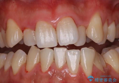 1年ぶりの歯医者でクリーニングの治療後