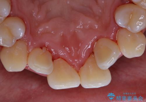 1年ぶりの歯医者でクリーニングの治療後