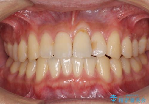 気になる前歯のデコボコをインビザラインで解消の治療中