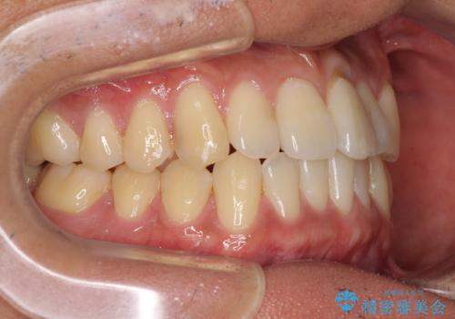 気になる前歯のデコボコをインビザラインで解消の治療中