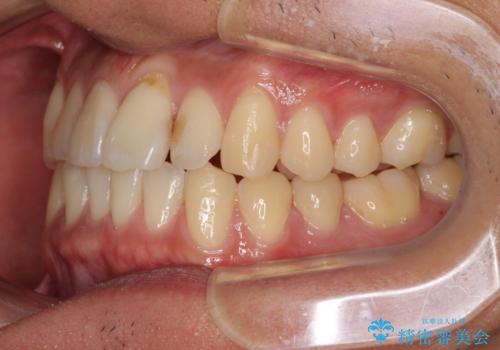 気になる前歯のデコボコをインビザラインで解消の治療中