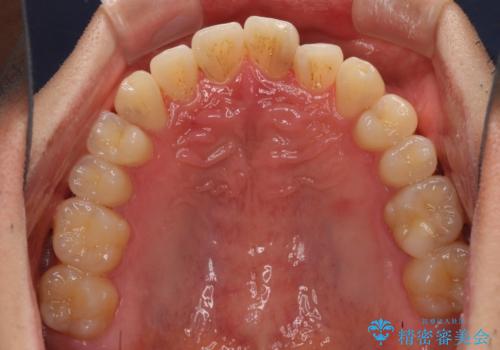 気になる前歯のデコボコをインビザラインで解消の治療中