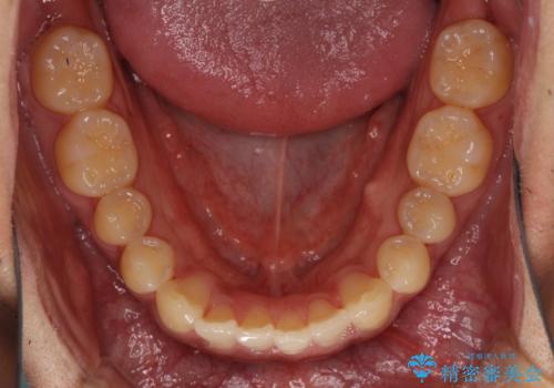 気になる前歯のデコボコをインビザラインで解消の治療中