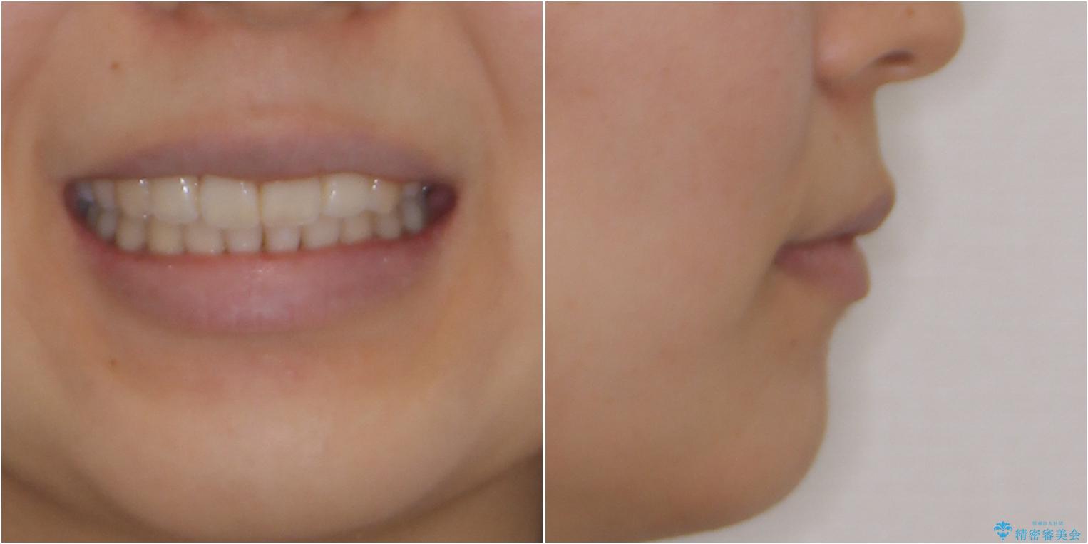 スッキリとした口元へ 出っ歯の抜歯矯正の治療後(顔貌)