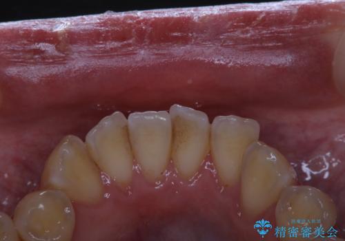 歯科医院での専門的なクリーニンングの治療前