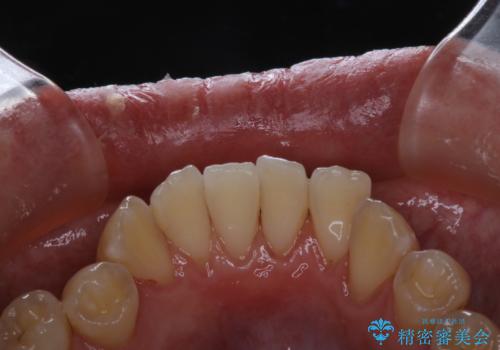 歯科医院での専門的なクリーニンングの治療後