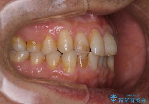 インビザラインでのマウスピース矯正中にPMTCで着色をきれいにの治療前