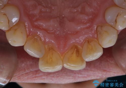 インビザラインでのマウスピース矯正中にPMTCで着色をきれいにの治療前