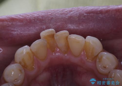 インビザラインでのマウスピース矯正中にPMTCで着色をきれいにの治療前